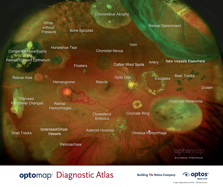 optomap diagnostic atlas