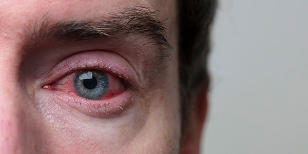 Eye with blepharitis