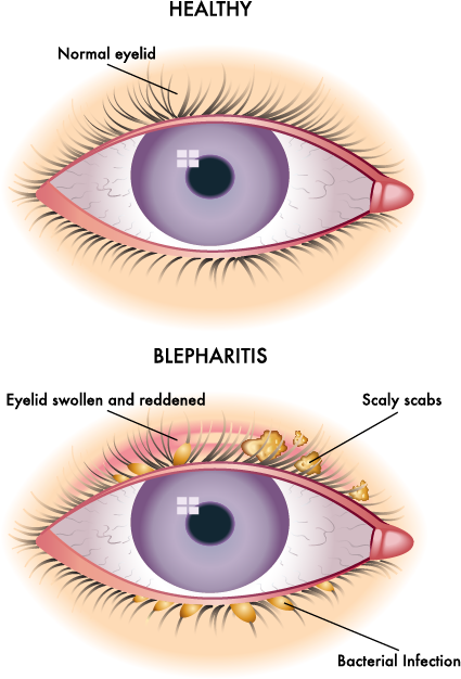 blepharitis eye illustration
